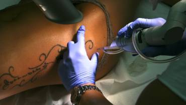 Laser-Tattooentfernung setzt Geduld voraus!