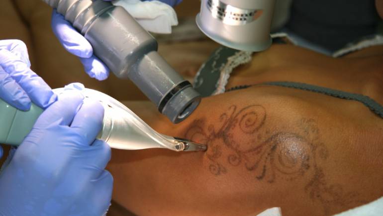 Eine erfolgreiche Tattooentfernung beinhaltet eine optimale Nachsorge